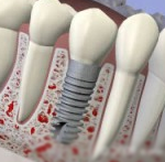 Ant implanto fiksuojamas danties vainikėlis