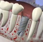 Dantų implantas apatiniame žandikaulyje