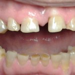 1. Dantu nudilimo pažeisti dantys prieš gydymą